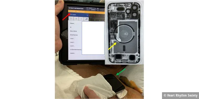 Beobachtung der Forscher: Das iPhone 12 wurde im Brustbereich des Patienten platziert (grüner Pfeil), dies führte zur Pausierung des Defibrillators (roter Pfeil).