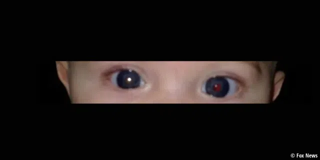 Das eine Auge rot, das andere weiß. Anhand dieses Fotos entdeckte die Mutter den Krebs ihres kleinen Sohnes.